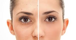 Fractional CO2 Laser Treatment in Guntur