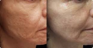 Fractional CO2 Laser Treatment in Guntur